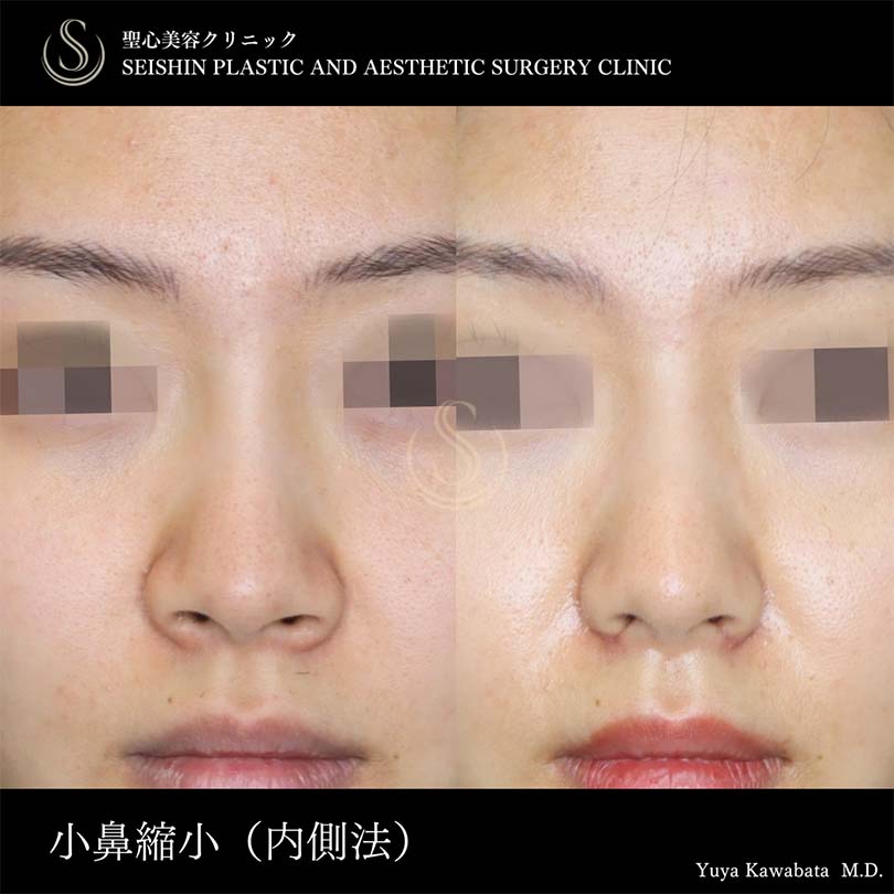 小鼻縮小_Before