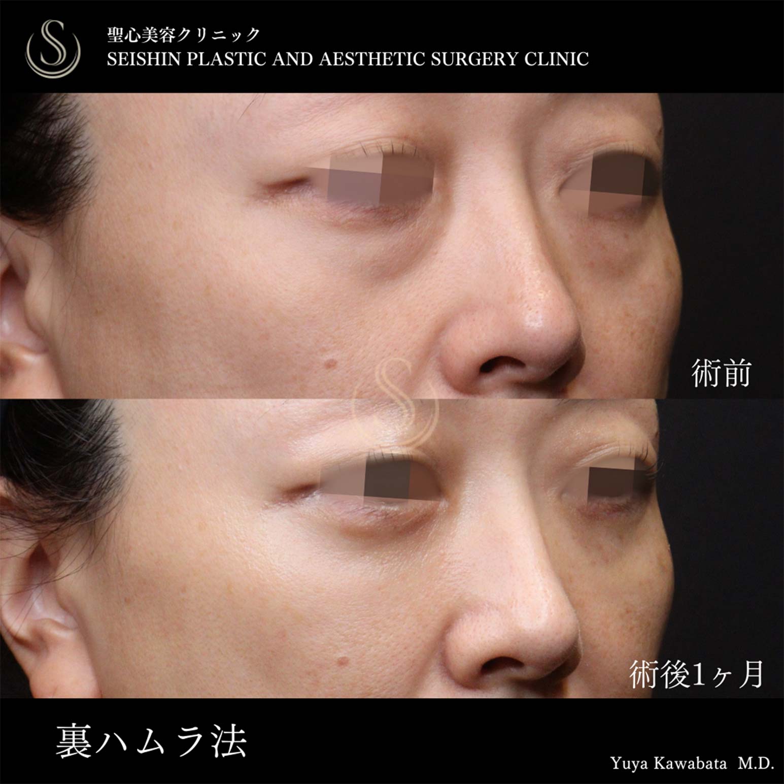 下眼瞼切開術/下眼瞼除皺術/ハムラ法_After