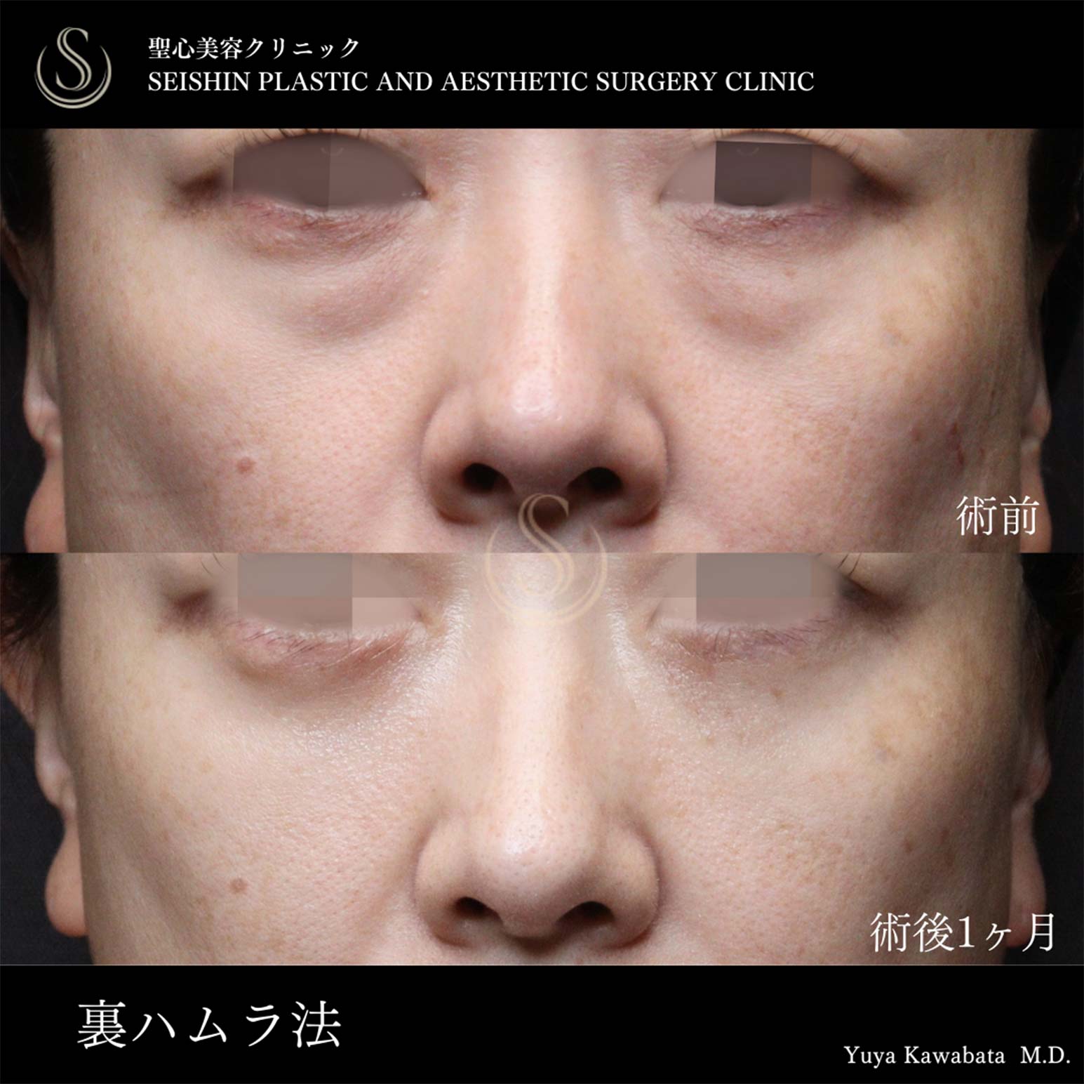 下眼瞼切開術/下眼瞼除皺術/ハムラ法_Before