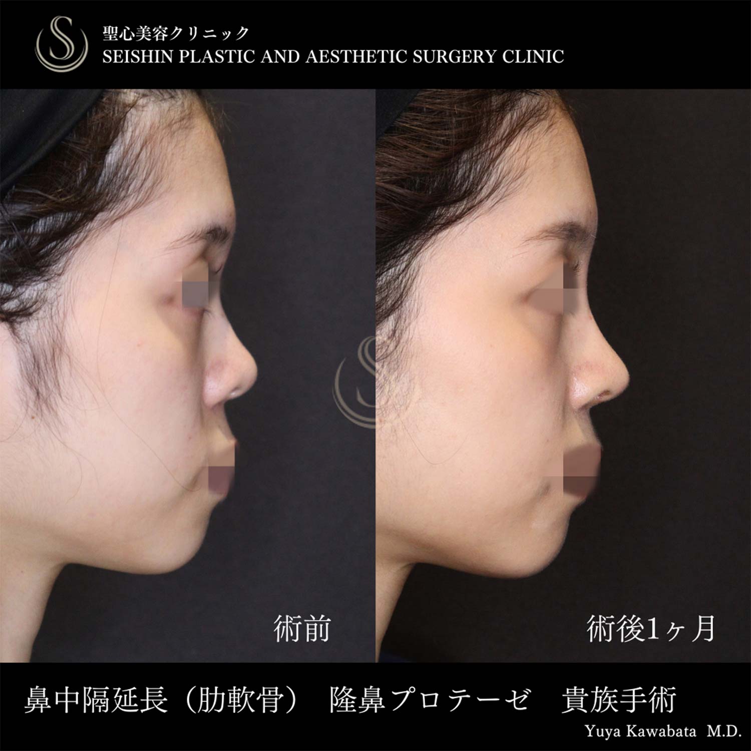 鼻中隔延長術＋鼻尖縮小＋プロテーゼによる隆鼻術_Before