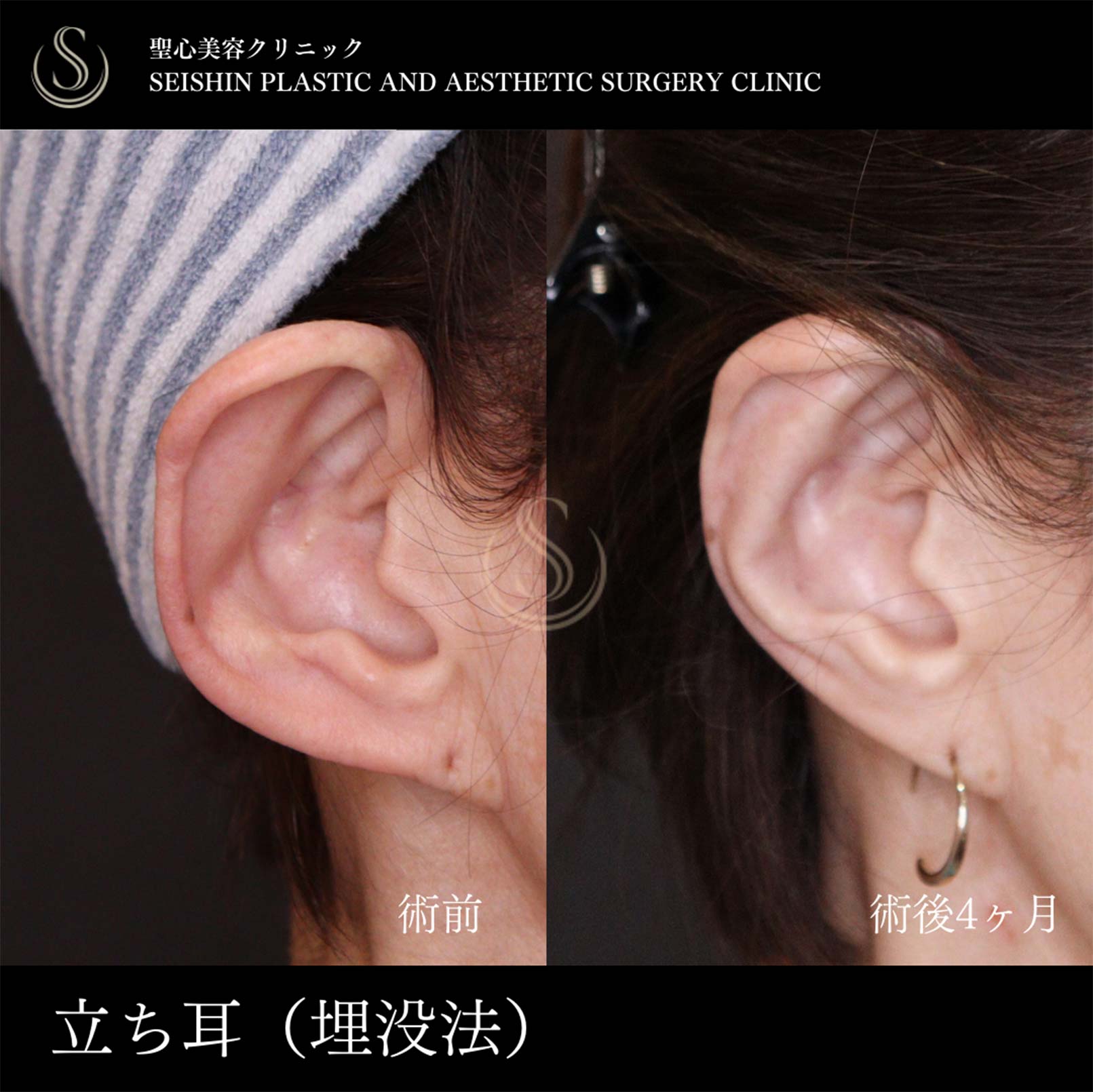 立ち耳修正（埋没法）_Before