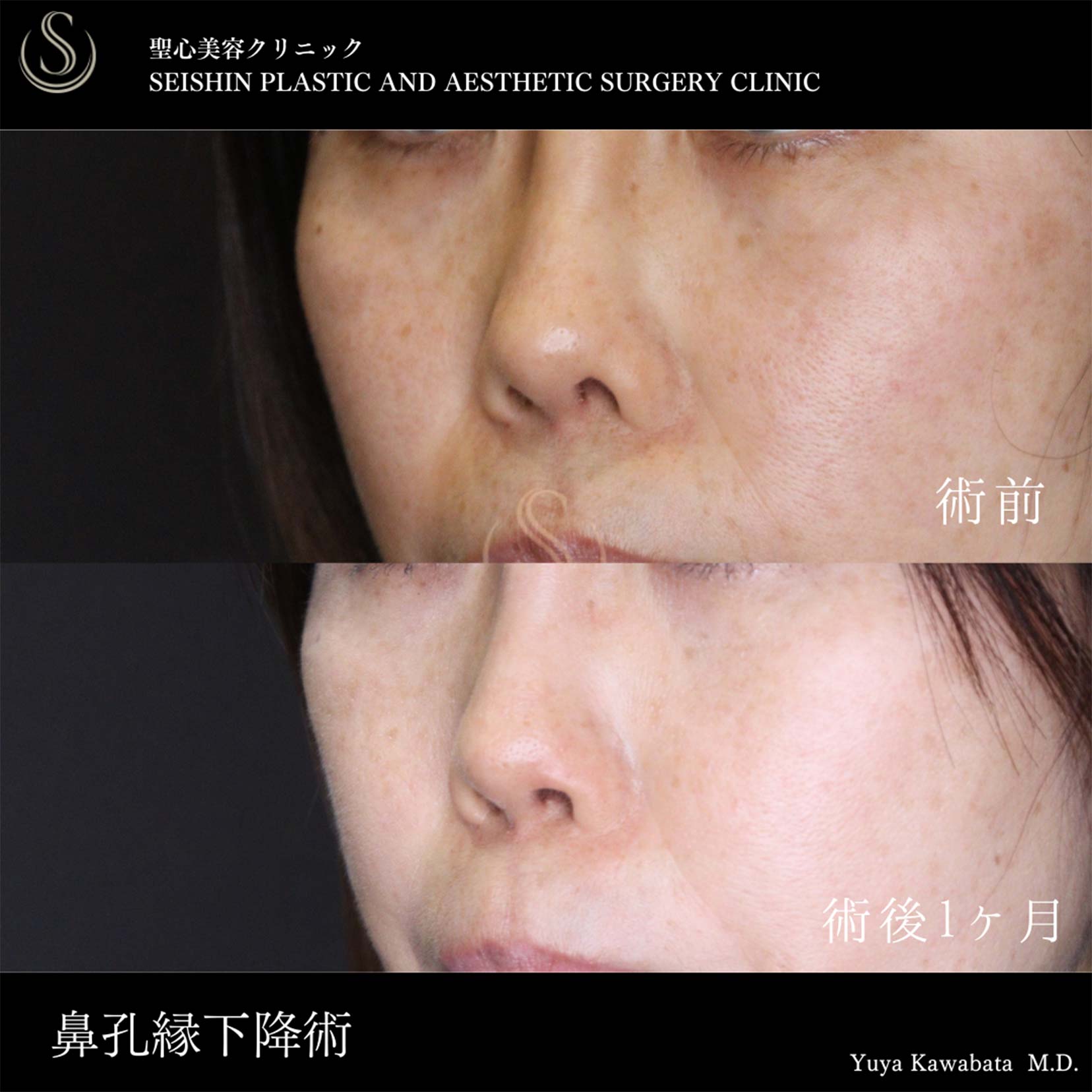 鼻孔縁下降術_After