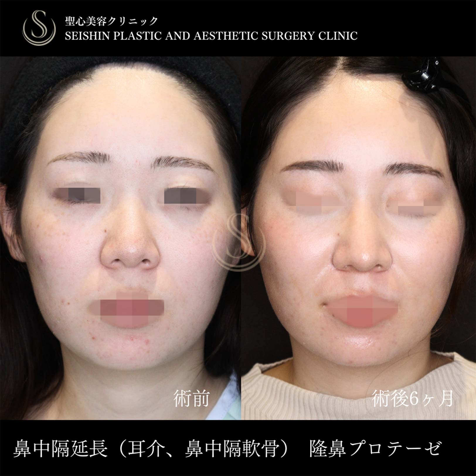 鼻中隔延長術＋鼻尖縮小＋プロテーゼによる隆鼻術_After