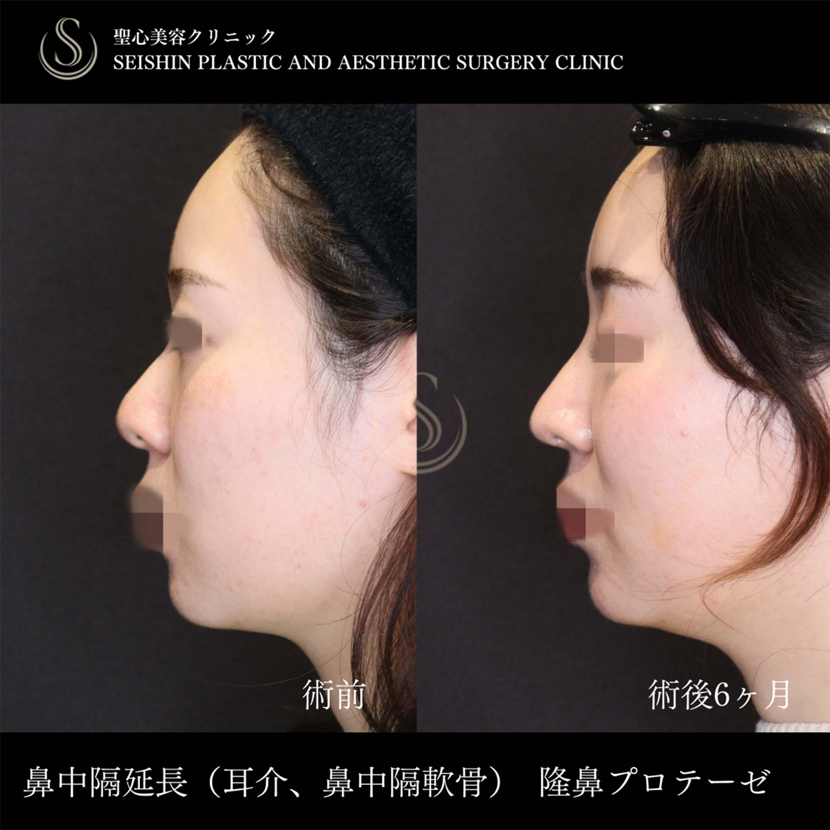 鼻中隔延長術＋鼻尖縮小＋プロテーゼによる隆鼻術_Before