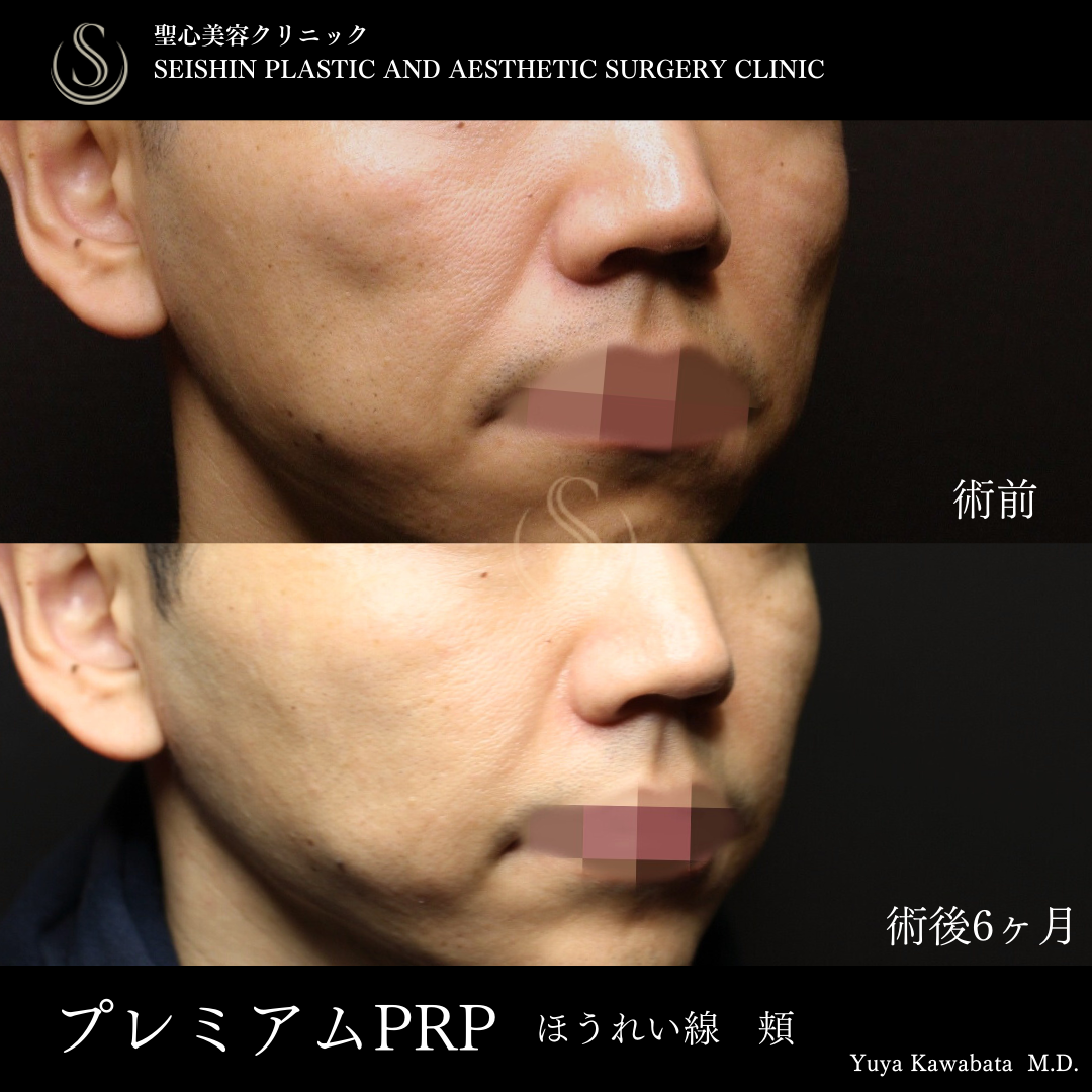 プレミアムPRP皮膚再生療法_After