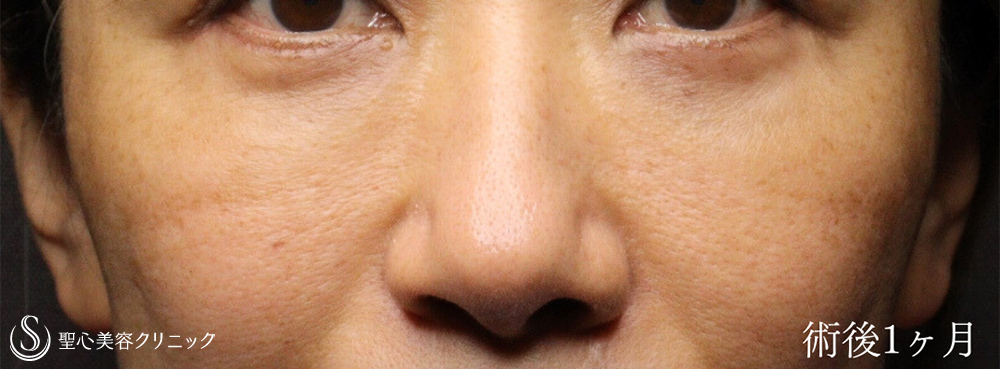 下眼瞼切開術/下眼瞼除皺術/ハムラ法_After