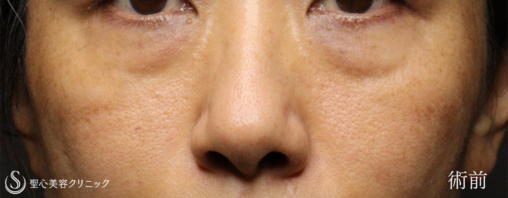 下眼瞼切開術/下眼瞼除皺術/ハムラ法_Before