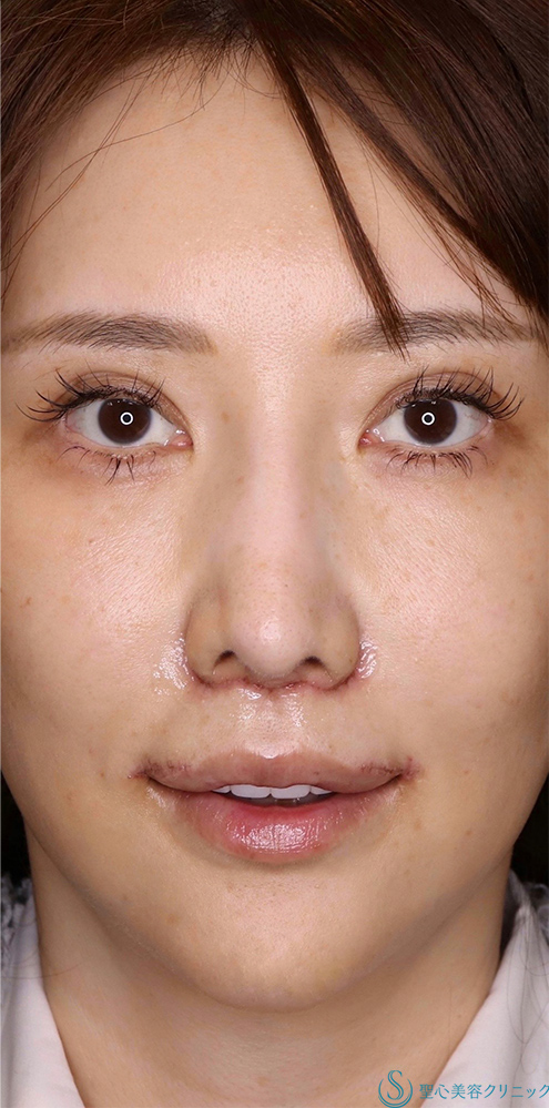 鼻下短縮術（リップリフト/人中短縮）＋外側人中短縮術_After