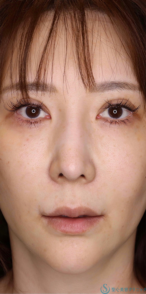 鼻下短縮術（リップリフト/人中短縮）＋外側人中短縮術_Before