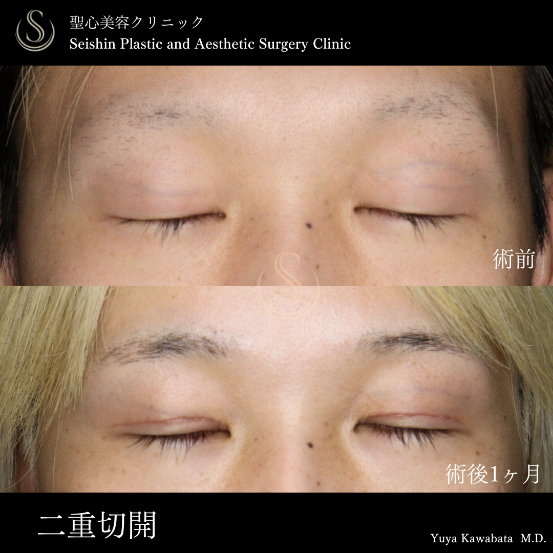 二重術（切開法）部分切開/全切開_After