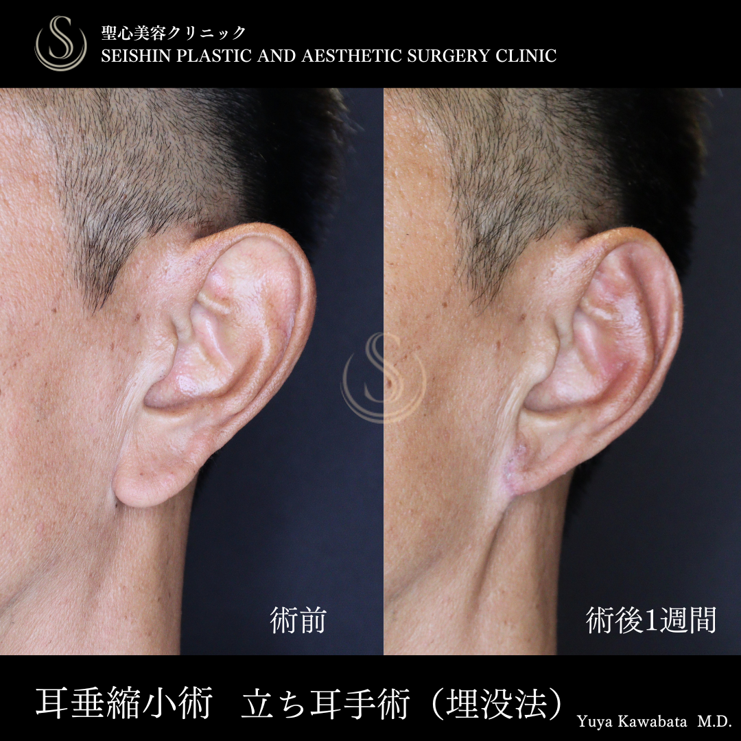 耳たぶ修正/立ち耳修正（埋没法）_After