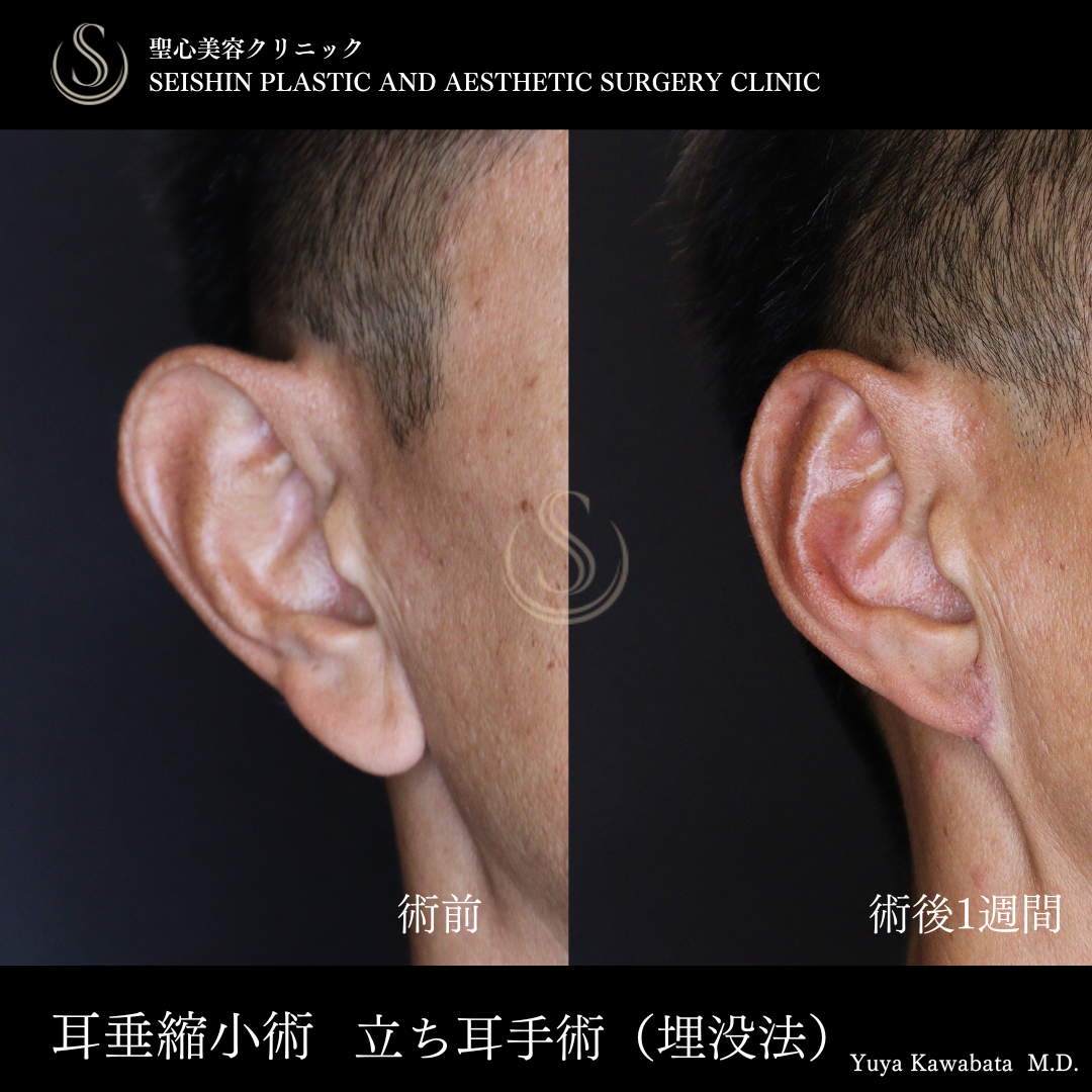 耳たぶ修正/立ち耳修正（埋没法）_Before