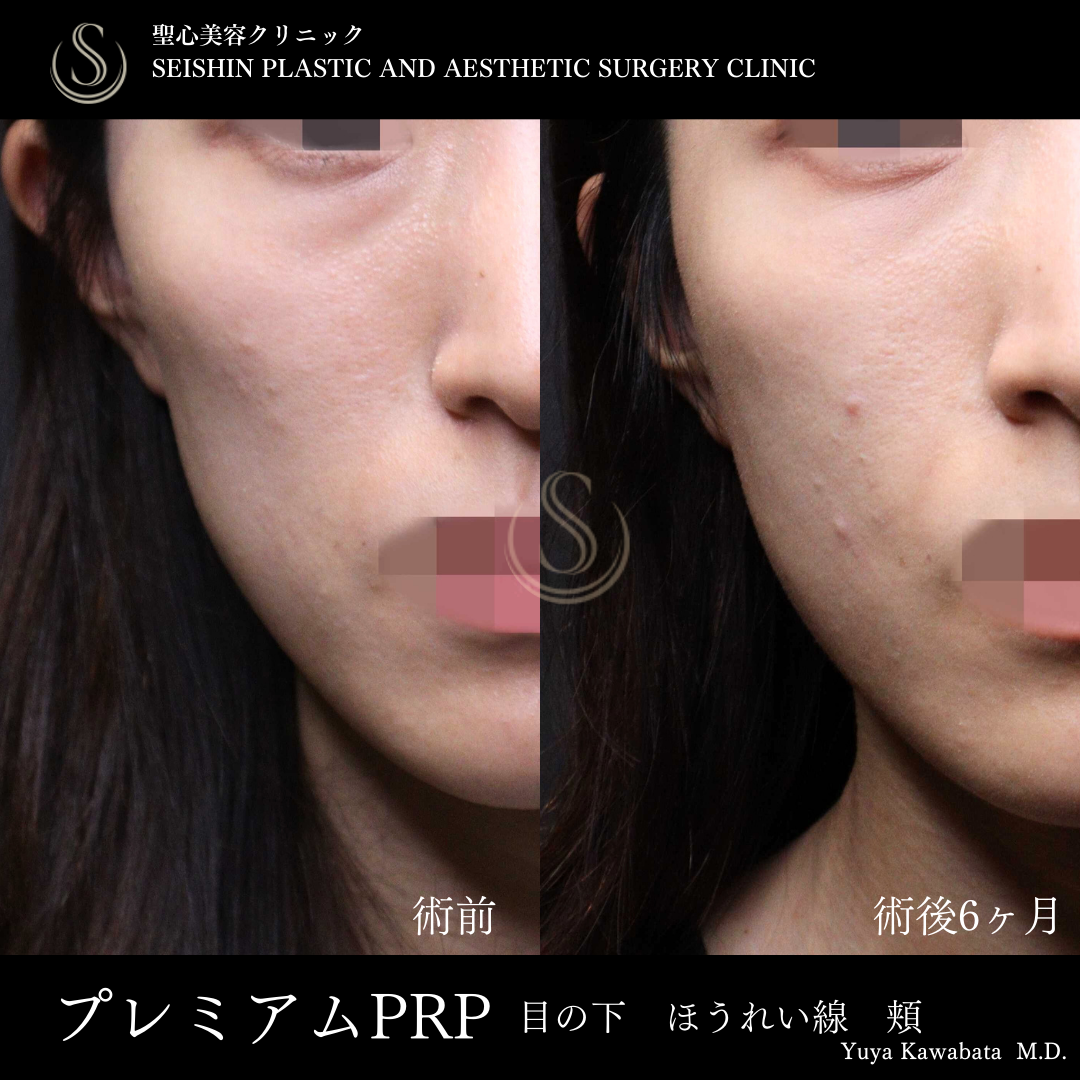 プレミアムPRP皮膚再生療法‗After