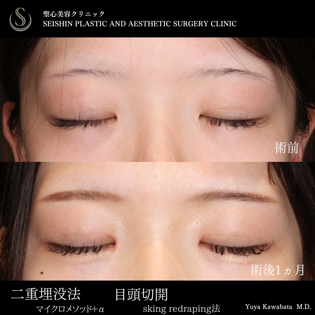 二重術（埋没法）マイクロメソッド+α＋目頭切開_After