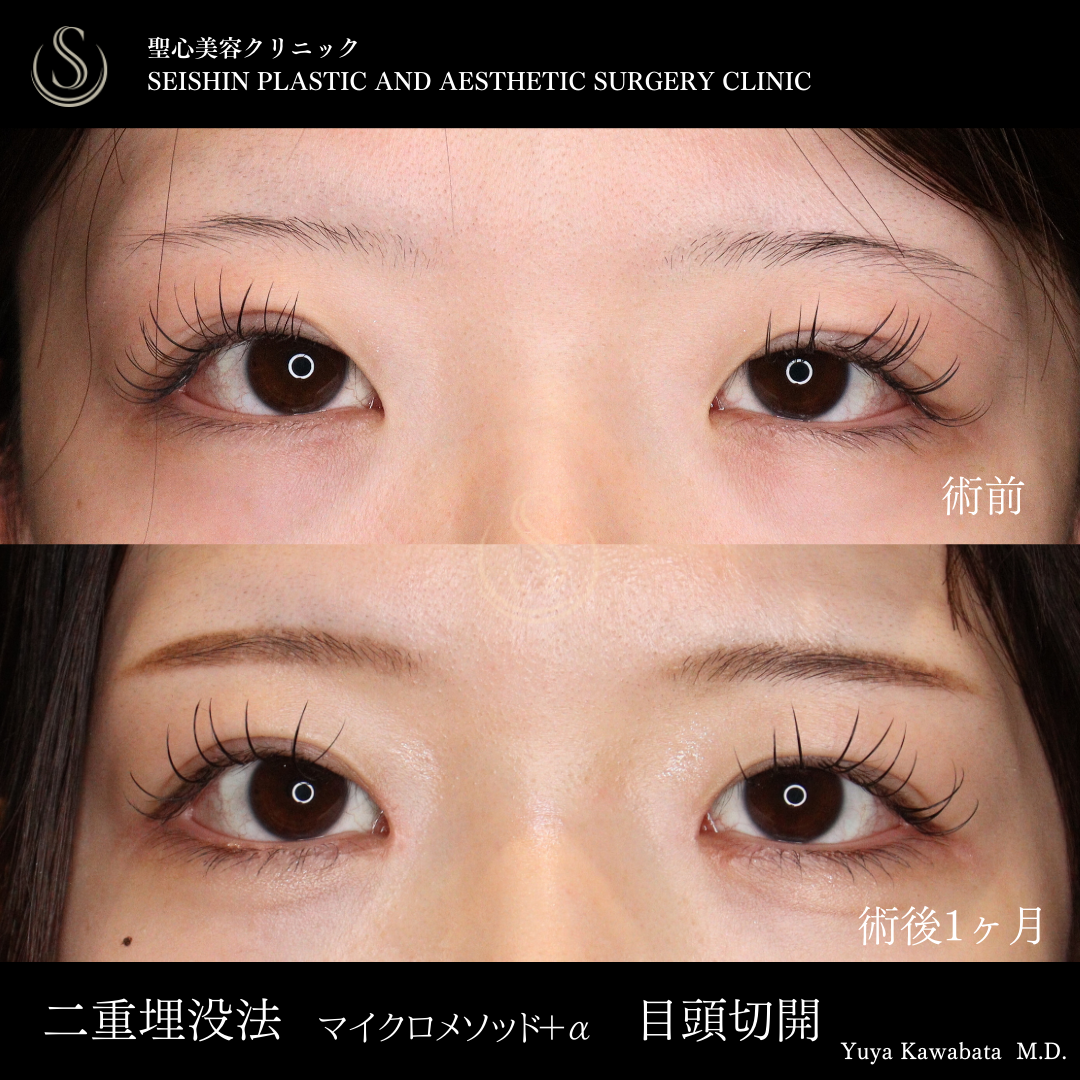 二重術（埋没法）マイクロメソッド+α＋目頭切開_Before