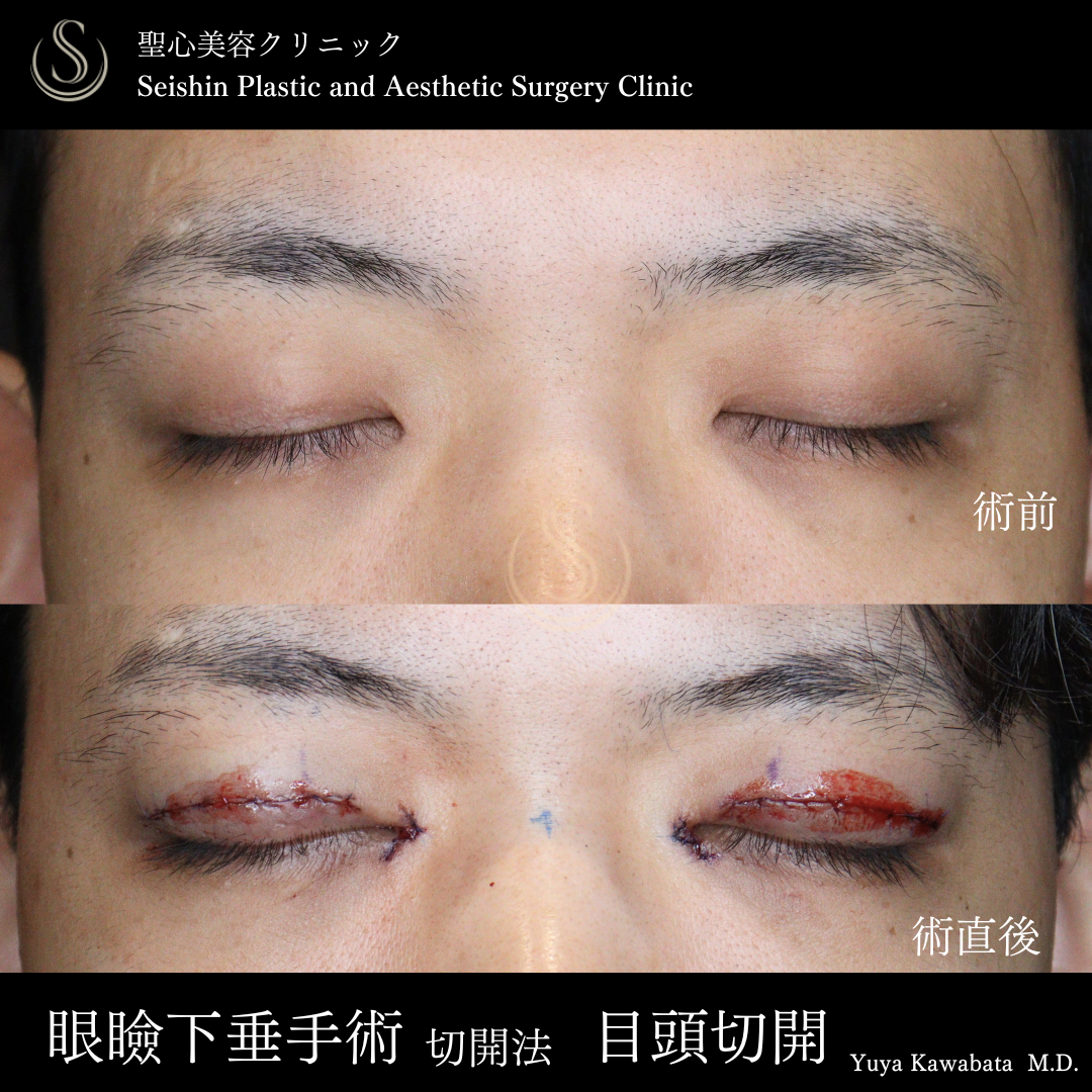  眼瞼下垂（切開法/腱膜縫縮法）＋目頭切開/目上切開_After