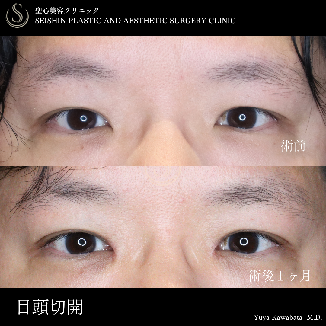目頭切開/目上切開_Before