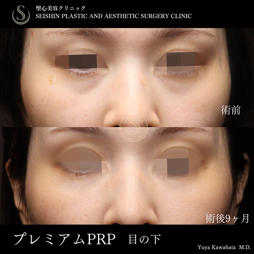 プレミアムPRP皮膚再生療法_Before