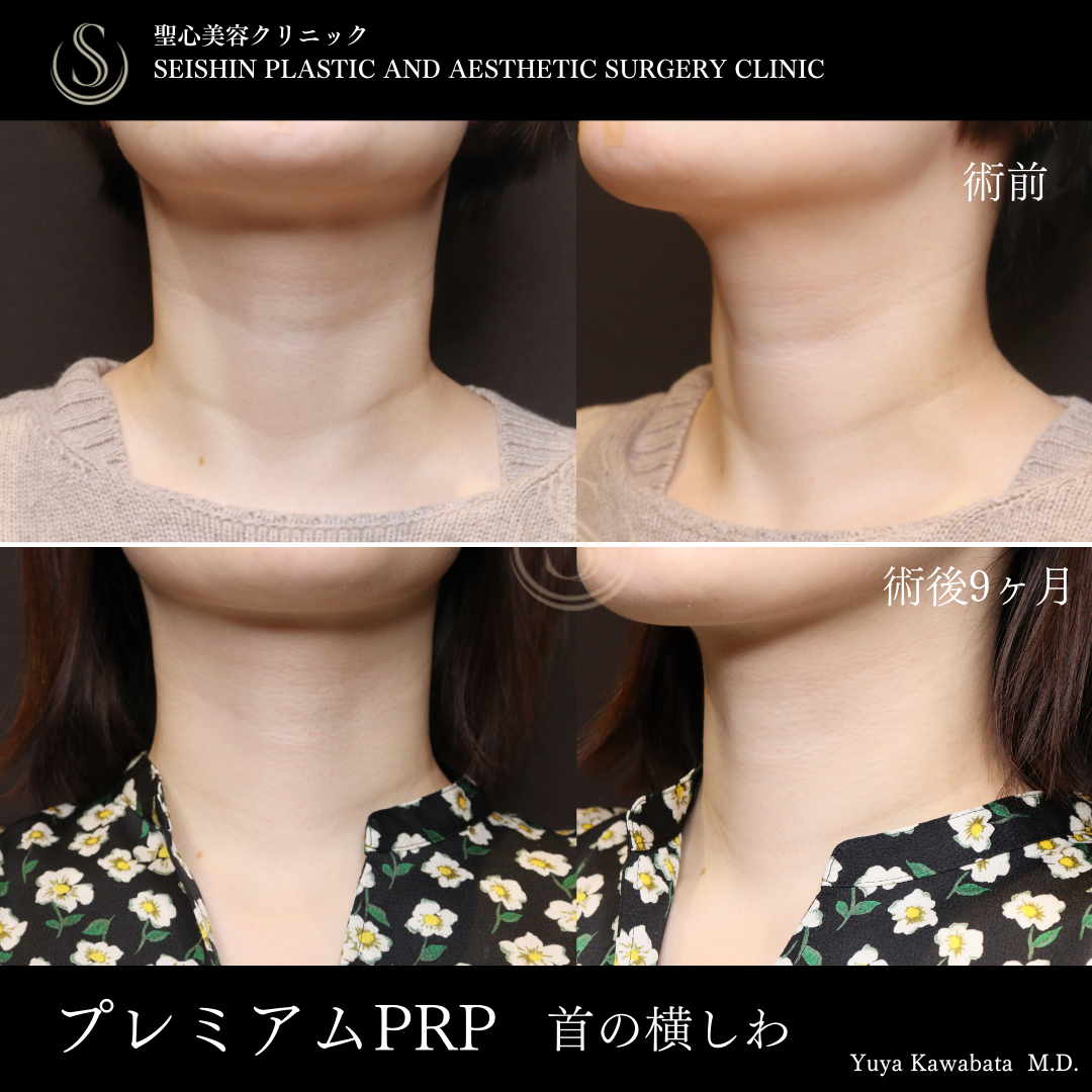 プレミアムPRP皮膚再生療法_Before