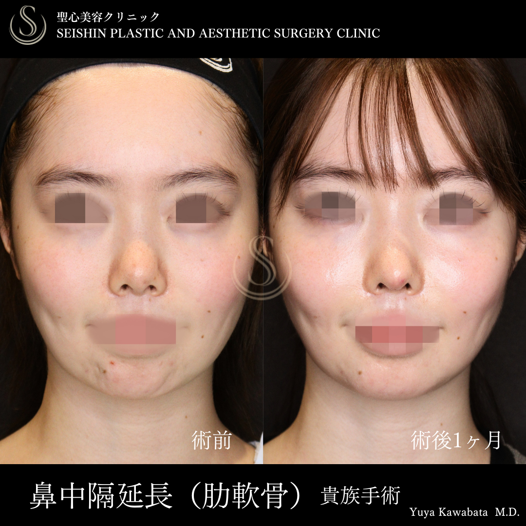 鼻中隔延長術（肋軟骨）＋鼻尖形成＋貴族手術_After
