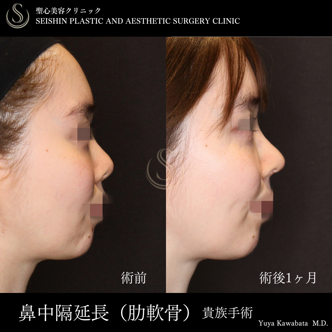鼻中隔延長術（肋軟骨）＋鼻尖形成＋貴族手術_Before