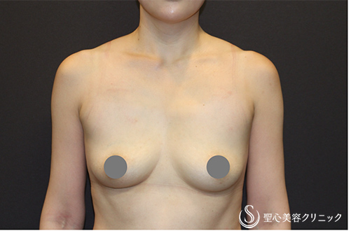 バックプロテーゼ挿入法（Motiva Ergonomix2 mini 220cc）_Before