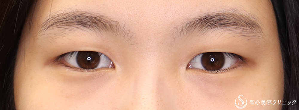 二重術（埋没法）：マイクロメソッド＋α（二重埋没法）_Before