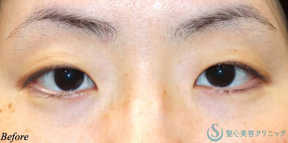 二重術（切開法）＋目頭切開/目上切開_Before