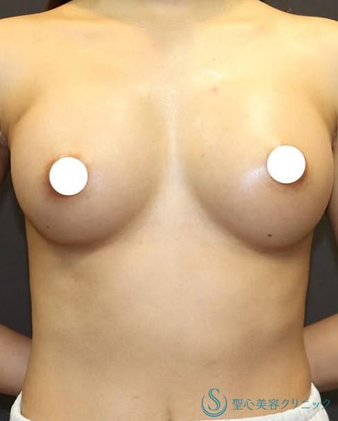 バッグプロテーゼ挿入法_After