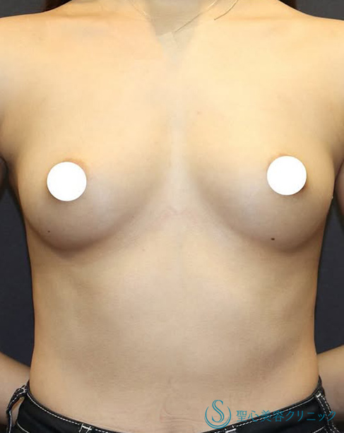 バッグプロテーゼ挿入法_Before