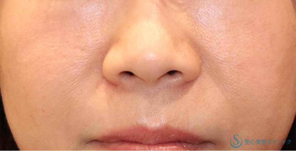 小鼻縮小（内側法＋外側法）_Before