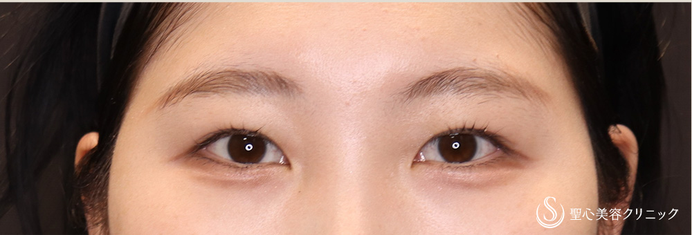 二重術（埋没法）：マイクロメソッド+α（二重埋没法）_After