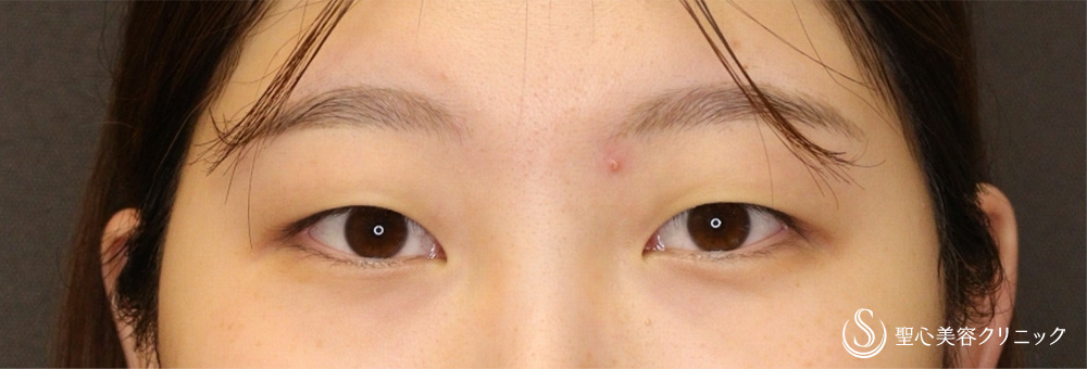 二重術（埋没法）：マイクロメソッド+α（二重埋没法）_Before