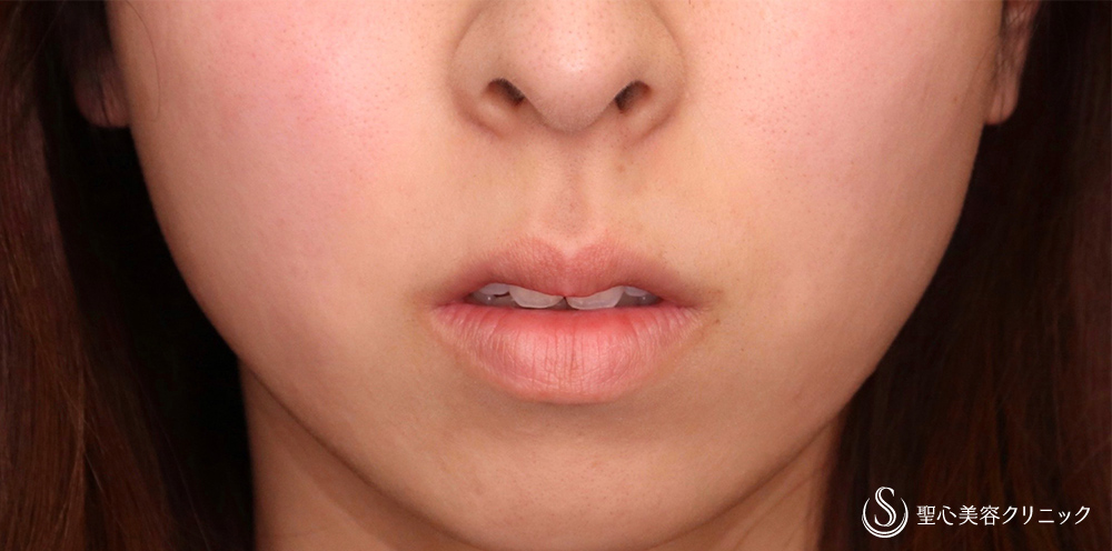 プレミアムリップリフト（プレミアム人中短縮術）_Before