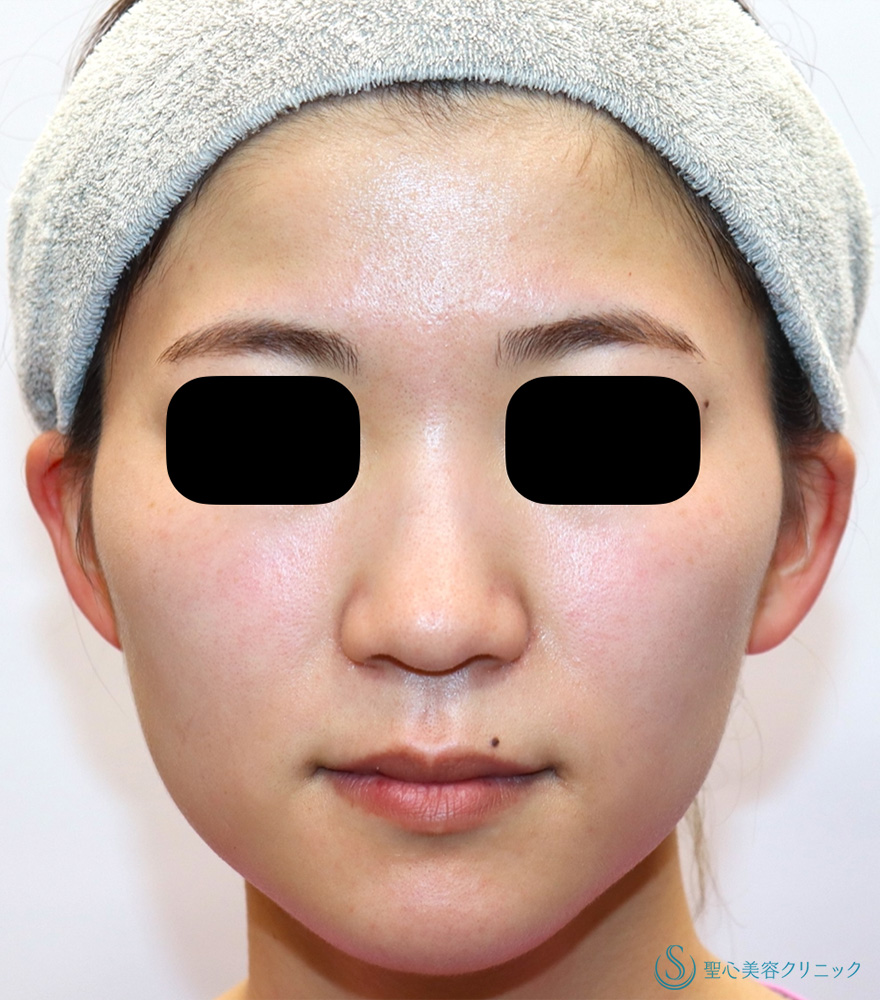 ボツリヌストキシン注入（注射）_After