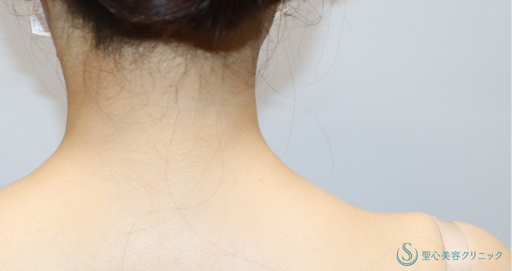 肩ボツリヌストキシン注入（注射）_After