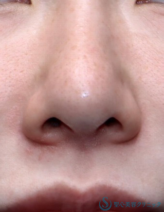 小鼻縮小_Before