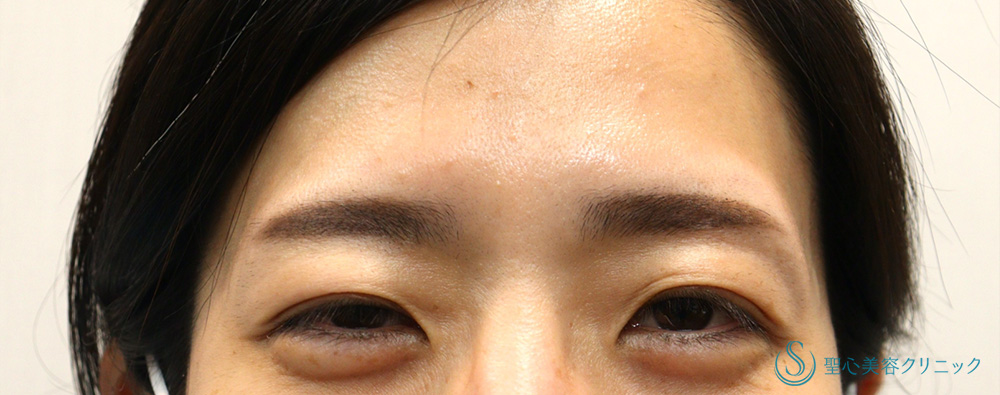 眉間ボツリヌストキシン注入（注射）_After