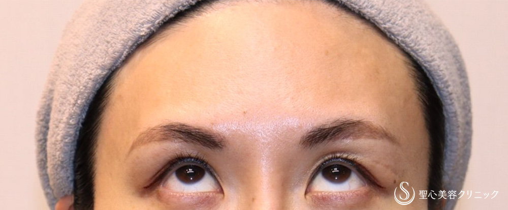 額ボツリヌストキシン注入（注射）_After