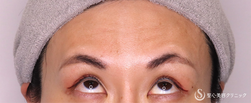 額ボツリヌストキシン注入（注射）_Before