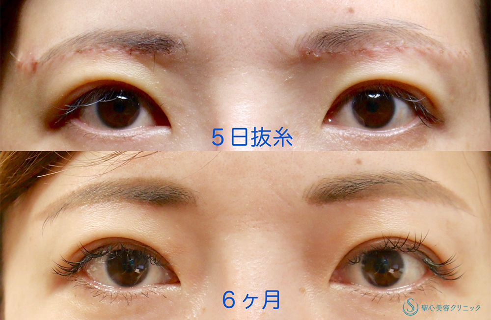 眉下切開法（眉下リフト）_After