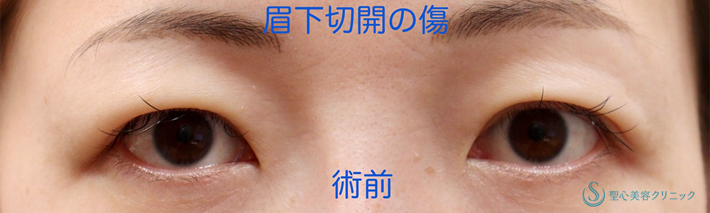 眉下切開法（眉下リフト）_Before