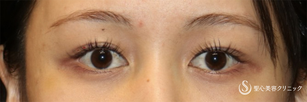 マイクロメソッド+α（二重埋没法）_Before