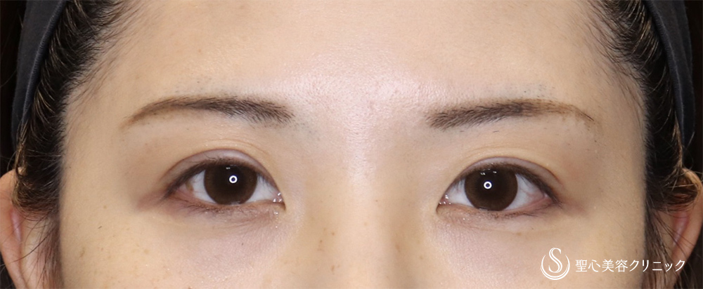 二重術（切開法）_After