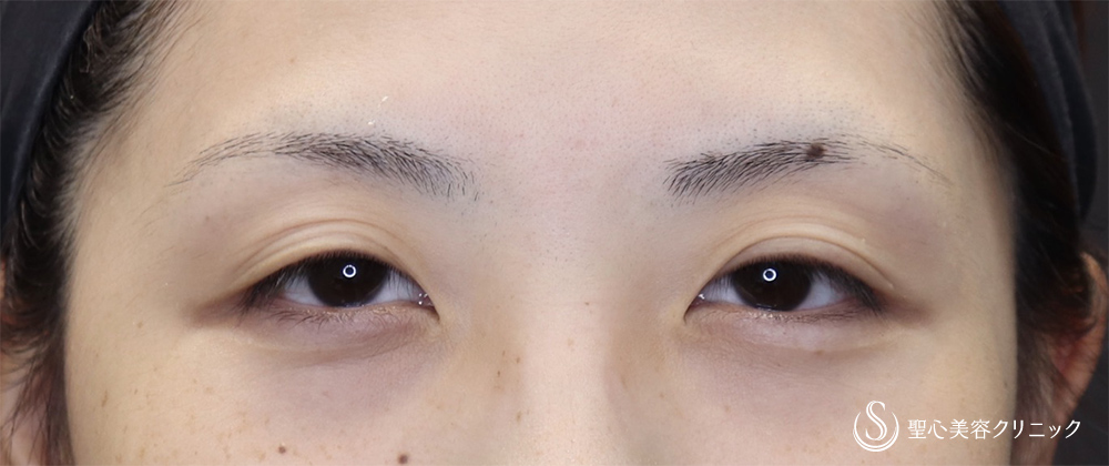 二重術（切開法）_Before