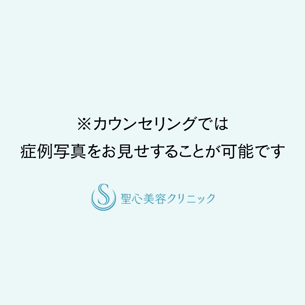 小陰唇縮小＋副皮除去_Before