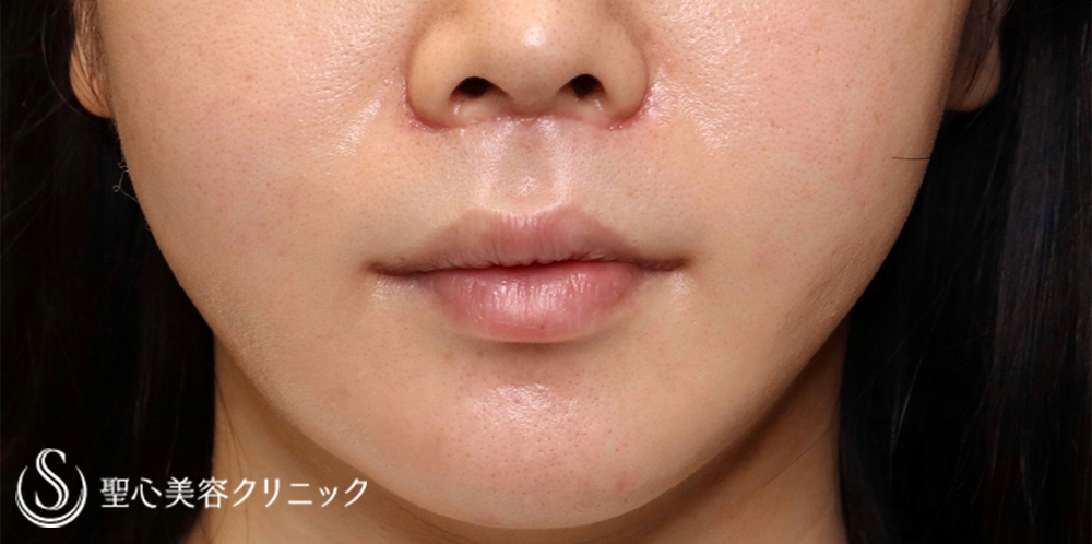 プレミアムリップリフト（プレミアム人中短縮術）＋プレミアム口角挙上術_After