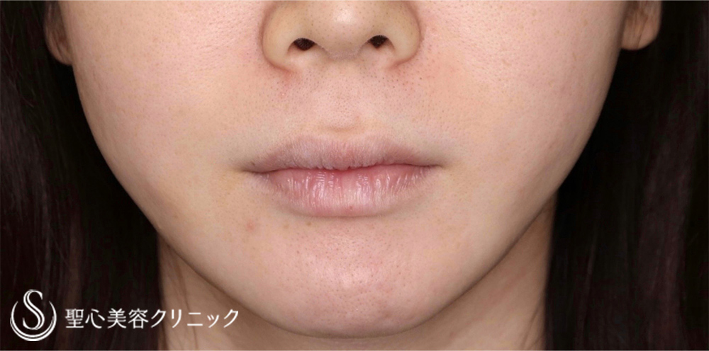 プレミアムリップリフト（プレミアム人中短縮術）＋プレミアム口角挙上術_Before