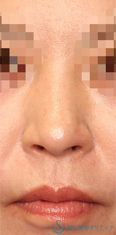 鼻孔縁下降術_After