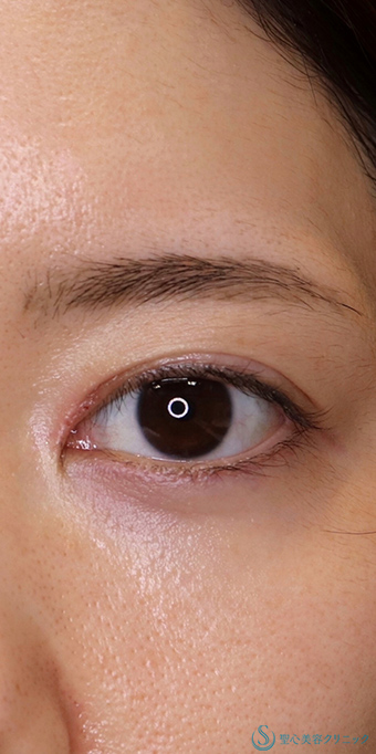 目上切開・修正_After